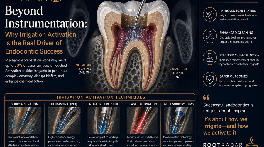 Beyond Instrumentation: Why Irrigation Activation Is the Real Driver of Endodontic Success